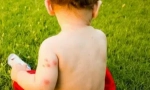 Šta da radim ako bebe bit insekti?
